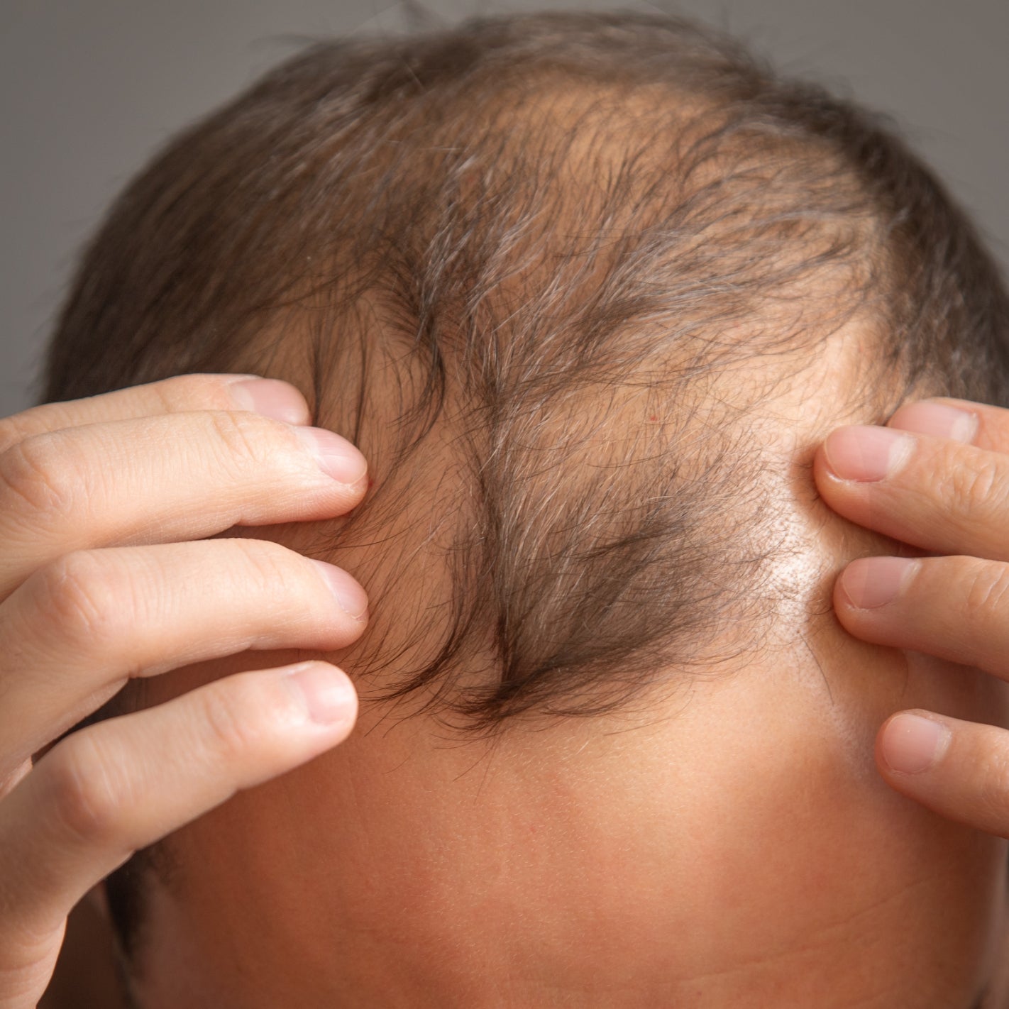 Nahaufnahme einer Stirn mit fortgeschrittenem Haarausfall – typisch für androgenetische Alopezie bei Männern