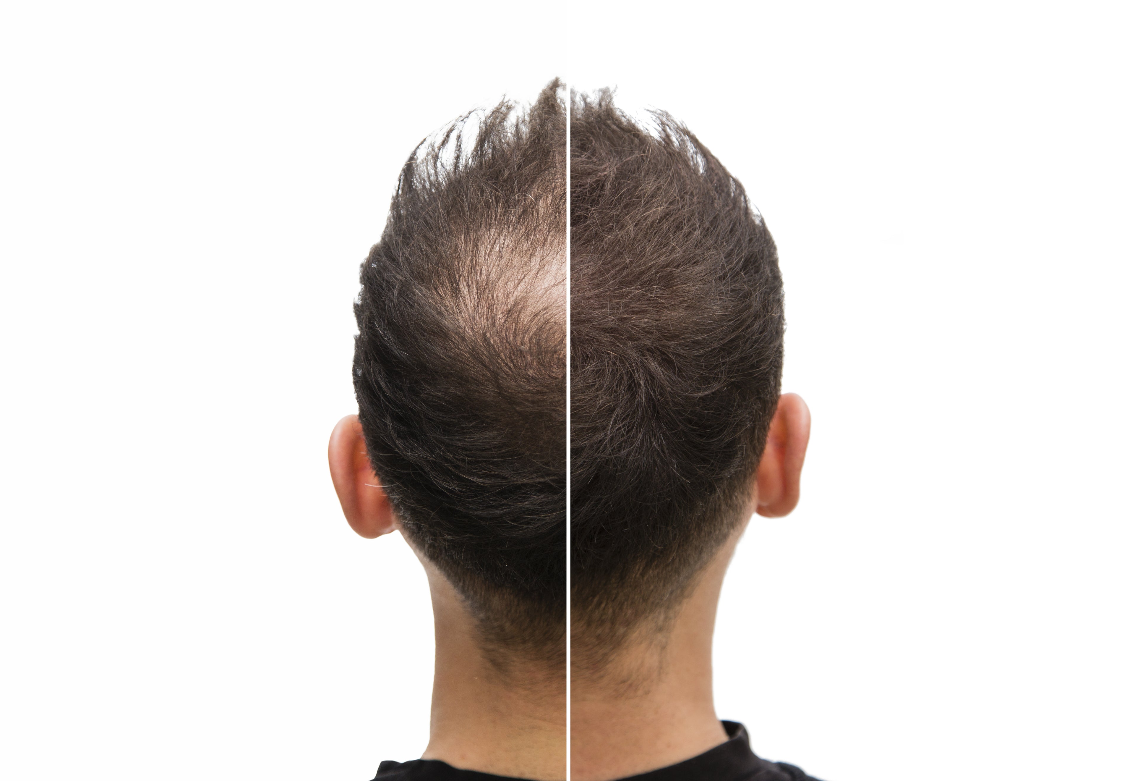 Vorher-Nachher-Vergleich des Hinterkopfs eines Mannes – sichtbare Verbesserung der Haardichte nach Haartransplantation